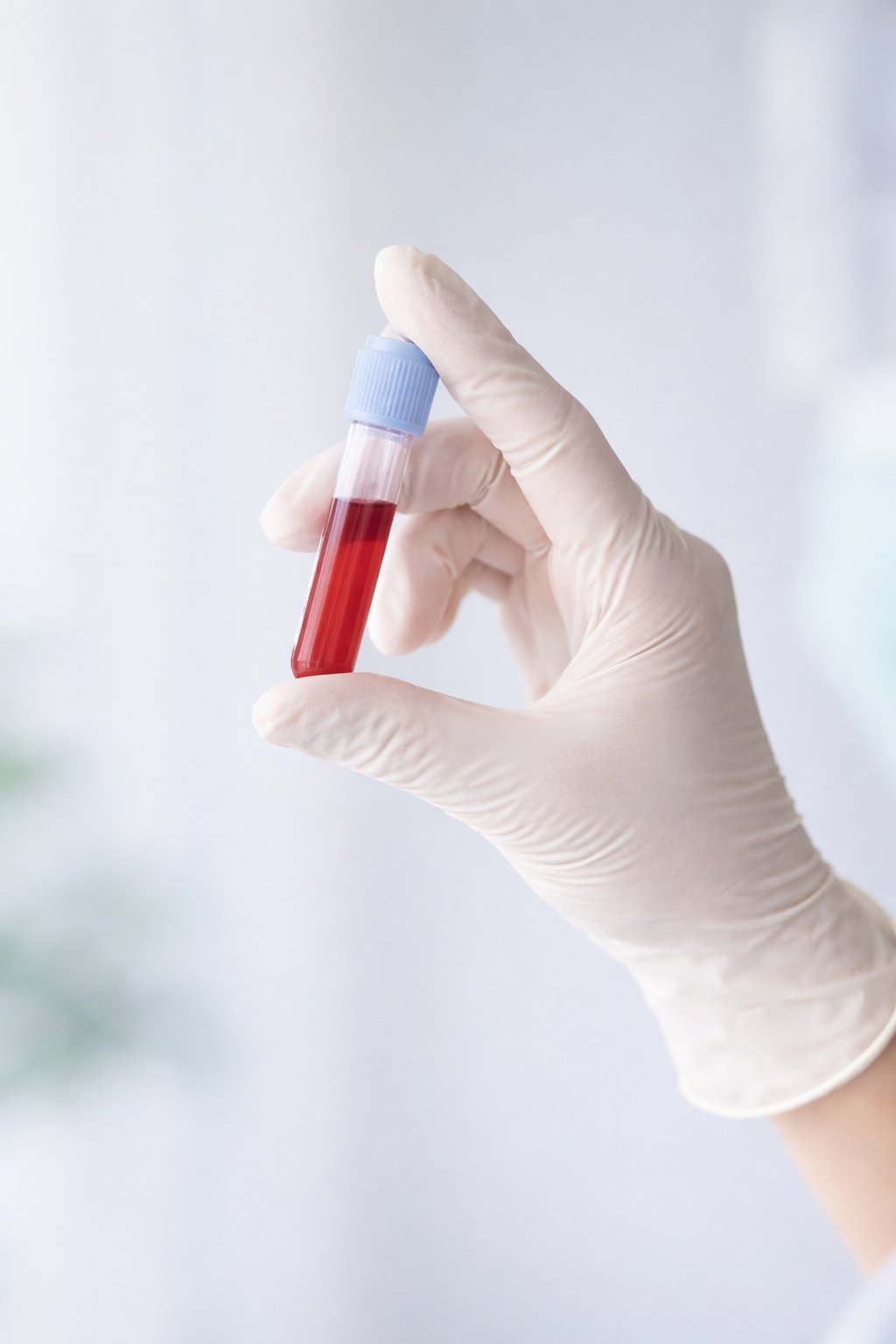 Análisis de laboratorio para alergias